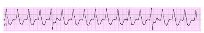 A 64-year-old man is admitted to the hospital with palpitations and lightheadedness for the past several days.  He has experienced palpitations previously, but recently they have seemed sustained and  uncomfortable.   The patient has had no chest pain or shortness of breath.  He has a history of coronary artery disease and prior percutaneous coronary interventions.  He is treated with metoprolol, lisinopril, aspirin, clopidogrel, and rosuvastatin.  Echocardiogram shows mild left ventricular dilation, a left ventricular ejection fraction of 30%, and no major valvular abnormality.  Serum potassium is 4.2 mEq/L and magnesium is 1.9 mg/dL.  On day 2 of hospitalization, the patient develops sudden-onset palpitations that feel like  fluttering in my chest.   Blood pressure is 122/60 mm Hg.  He is alert and does not appear to be in distress.  Examination shows clear lungs bilaterally.  His ECG strip is shown below.   Which of the following is the best next step in management of this patient? A) Amiodarone B) Carotid sinus massage C) Digoxin D) Electrical cardioversion E) Esmolol