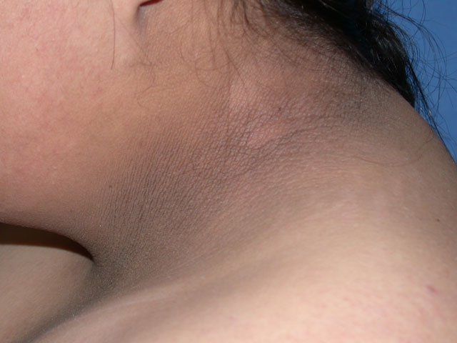 A 34-year-old woman comes to the physician for evaluation of skin lesions.  For the past year, she has noticed darkening and thickening of the skin over her neck and groin areas.  These areas occasionally feel itchy.  Her blood pressure is 130/80 mm Hg.  Skin examination findings are shown in the image below.   Similar hyperpigmented, velvety lesions are found on the axilla and groin.  This patient's condition is most likely associated with which of the following? A) Addison's disease B) Hemochromatosis C) Liver malignancy D) Pellagra E) Polycystic ovarian syndrome