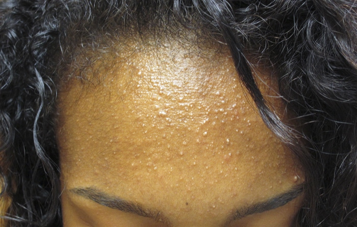 A 15-year-old, previously healthy girl comes to the office due to  spots  on her face.  About a year ago, the patient started having tiny bumps on her forehead; they have progressively increased in number and size.  She has used several over-the-counter facial cleansing products without relief.  The patient does not use tobacco, alcohol, or illicit drugs and is not sexually active.  Physical examination shows an oily complexion and the findings seen in the image below:   Which of the following is the best next step in management of this patient? A) Cessation of chocolate consumption B) Cream-based cleansers C) Oral contraceptives D) Systemic antibiotics E) Topical corticosteroid F) Topical retinoids