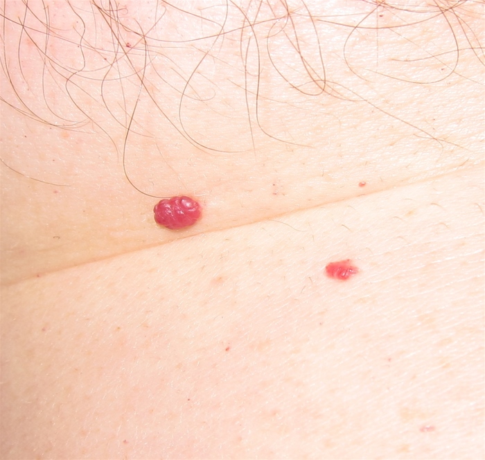 A 55-year-old man comes to the physician with red skin lesions on his abdomen.  The patient reports no associated symptoms but says his wife is concerned about possible malignancy.  He has hypertension and degenerative joint disease but no other medical problems.  Physical examination shows the findings in the image below:   Which of the following is the most likely diagnosis in this patient? A) Basal cell carcinoma B) Cavernous hemangioma C) Cherry angioma D) Kaposi sarcoma E) Spider angioma F) Strawberry (capillary)  hemangioma