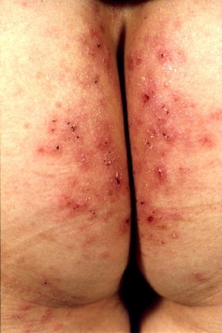 A 25-year-old woman comes to the physician with a rash on her buttocks.  The lesions began 10 days ago and are associated with intense itching and burning.  She has attempted treatment with cool compresses and calamine lotion without relief.  The patient has had occasional diarrhea and unintentional weight loss over the past few months.  Her medical history is otherwise unremarkable.  Her temperature is 37.1 C (98.8 F) , blood pressure is 117/76 mm Hg, pulse is 82/min, and respirations are 14/min.  The skin lesions are shown in the image below.   Which of the following is the most likely diagnosis of this patient's rash? A) Bullous pemphigoid B) Dermatitis herpetiformis C) Erythema multiforme D) Herpes zoster E) Pemphigus vulgaris F) Psoriasis