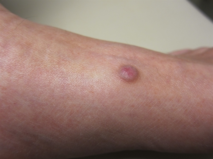 A 26-year-old woman comes to the physician for evaluation of a lesion on her left foot.  She initially noticed a small bump 6-7 months ago that has gradually become firm and slightly pigmented.  She has no pain or itching around the site and has no other medical conditions.  The patient has no history of tobacco or alcohol use.  She works as an accountant.  Her temperature is 36.1 C (97 F) , blood pressure is 128/76 mm Hg, and pulse is 78/min.  Skin examination (shown below)  reveals a 0.8 cm hyperpigmented nodule with dark edges.  There is a central dimple that develops when the lesion is pinched at the edges.  The remainder of her physical examination is within normal limits.   Which of the following is the most likely diagnosis? A) Basal cell carcinoma B) Dermatofibroma C) Kaposi sarcoma D) Pyogenic granuloma E) Squamous cell carcinoma