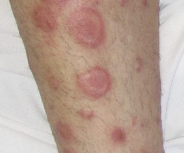 A 26-year-old man comes to the office due to upper and lower limb skin lesions that have been present for the past week.  The lesions started as small, red papules that gradually enlarged but are not painful or pruritic.  The patient had similar lesions several months ago and was told that the antibiotic prescribed for a dental infection could be the cause.  The lesions spontaneously resolved in about 2 weeks.  Prior to the current episode, he was not taking any medications.  The patient occasionally drinks alcohol and does not use tobacco or illicit drugs.  Temperature is 36.6 C (98 F) , blood pressure is 126/78 mm Hg, and pulse is 76/min.  Skin examination shows several lesions (shown below)  scattered over the extremities with relative sparing of the trunk.   There is no mucous membrane involvement.  Which of the following is most likely related to this patient's skin condition? A) Contact with an individual having similar lesions B) Ingestion of a food allergen C) Occupational skin trauma from vegetation D) Recent bite from an Ixodes scapularis tick E) Recurrent episodes of painful genital ulcers