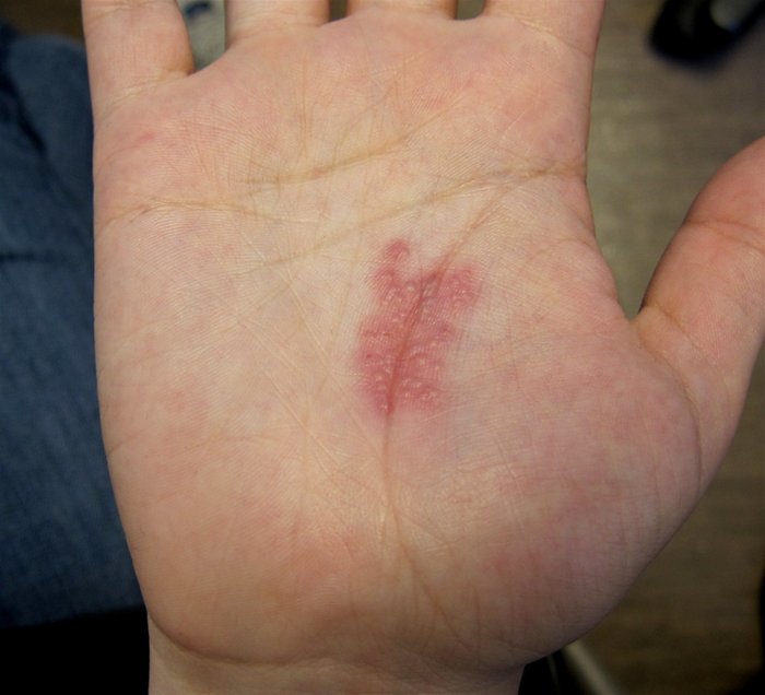 A 19-year-old college student comes to the office due to painful lesions on his right hand for the past several days.  He has also felt feverish and tired.  The patient has a history of folliculitis and skin abscess requiring surgical drainage.  Over the past 6 months, he has had 3 sexual partners and uses condoms inconsistently.  He began a part-time landscaping job a month ago.  Temperature is 37.4 C (99.3 F) , blood pressure is 130/84 mm Hg, and pulse is 86/min.  Right hand examination findings are shown below.   He has no other skin rash and the remainder of the physical examination is normal.  Which of the following is the most likely causative organism of this patient's condition? A) β-hemolytic streptococci B) Coxsackievirus C) Herpes simplex virus D) Neisseria gonorrhoeae E) Pseudomonas aeruginosa F) Rickettsia rickettsii G) Staphylococcus aureus H) Treponema pallidum I) Trichophyton rubrum