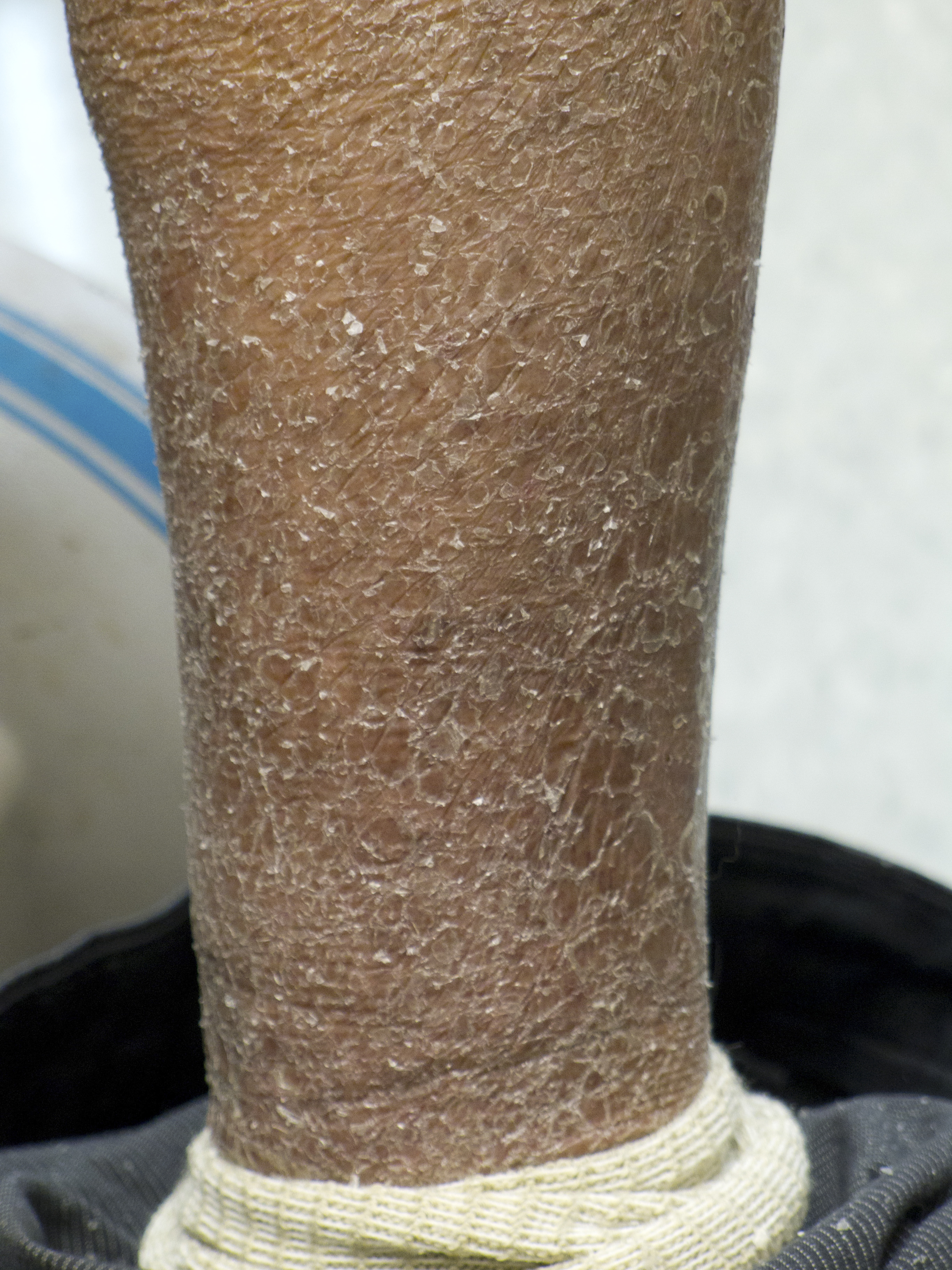 A 66-year-old woman comes to the office due to rough, dry, and scaly skin.  She has had these symptoms intermittently for most of her life, but they worsen during the winter and have become progressively worse in the last several years.  The patient has associated mild itching but no erythema or exudates.  She has attempted to treat her symptoms with topical emollients but has been unable to eliminate the problem.  Medical history is unremarkable, and the patient does not smoke or drink alcohol.  Vital signs are normal.  An image of the patient's skin is shown below.   Examination of the hands reveal increased major and minor lines in the palms.  Which of the following is the most likely diagnosis? A) Atopic dermatitis B) Dry skin C) Ichthyosis vulgaris D) Irritant contact dermatitis E) Psoriasis