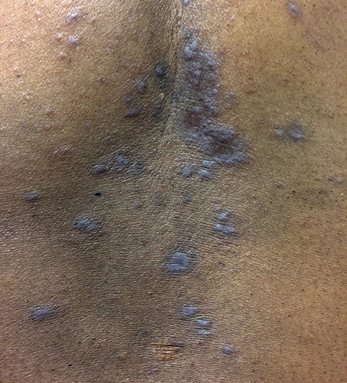 A 49-year-old man comes to the office for evaluation of a pruritic rash on his back.  The rash has been present for a few months and has been unrelenting.  The itching disturbs his sleep, and over-the-counter antihistamines have not helped.  Medical history is significant for primary hypertension, for which he takes hydrochlorothiazide and lisinopril.  Vital signs are normal.  The patient's skin findings are shown in the image below:   Which of the following is the most likely diagnosis? A) Atopic dermatitis B) Dermatitis herpetiformis C) Lichen planus D) Pityriasis rosea E) Psoriasis F) Tinea versicolor