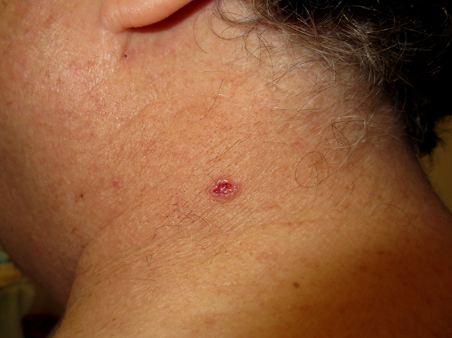 A 48-year-old woman comes to the office due to a lesion on her neck.  The lesion has been present for the past 6 months and is slowly enlarging.  Skin findings are shown in the image below.   Which of the following is the most likely diagnosis? A) Basal cell carcinoma B) Keratoacanthoma C) Pyoderma gangrenosum D) Pyogenic granuloma E) Squamous cell carcinoma