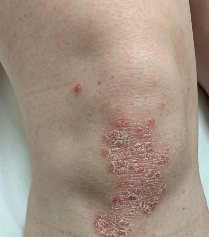 A 35-year-old man comes to the office due to skin lesions on his knees for the past several months.  The lesions began as small papules and gradually increased in size but are not painful or itchy.  The patient attributes the symptoms to frequent kneeling for his work as a plumber.  He tried several over-the-counter emollients but has had no relief and feels embarrassed to go out wearing shorts.  The patient has no other medical conditions and does not use tobacco, alcohol, or illicit drugs.  Vital signs are within normal limits.  Knee examination reveals bilateral findings as shown below.  The remainder of the examination shows no abnormalities.   Which of the following is the most appropriate management for this patient's skin lesions? A) Allergen avoidance B) Gluten-free diet C) Hydroxychloroquine D) Topical antifungal E) Topical glucocorticoid F) Tumor necrosis factor-alpha inhibitor