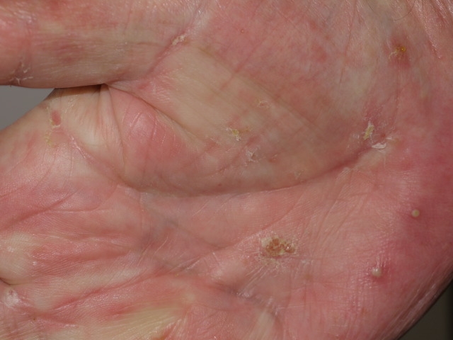 A 45-year-old woman comes to the office with a 10-day history of a pruritic rash.  The rash initially started on her hands and quickly spread to her fingers, wrists, and elbows.  The itching is particularly pronounced at night.  The patient works as a flight attendant and recently returned from an international trip, during which she stayed in a hotel for 3 days.  Her roommate also developed similar symptoms a week after the patient did.  The patient has no other medical conditions and takes no medications.  She has one sexual partner and uses condoms for contraception.  Her mother has a history of atopic dermatitis.  Vital signs are normal.  Skin examination shows small erythematous papules on the palms with scattered vesicles and pustules on the finger webs, palms, and wrist creases as shown below.  There are numerous excoriations on the wrists and elbows.  The remainder of the examination is within normal limits.   Which of the following is the most likely diagnosis? A) Bed bug infestation B) Bullous pemphigoid C) Eczema D) Scabies E) Seborrheic dermatitis F) Secondary syphilis G) Urticaria