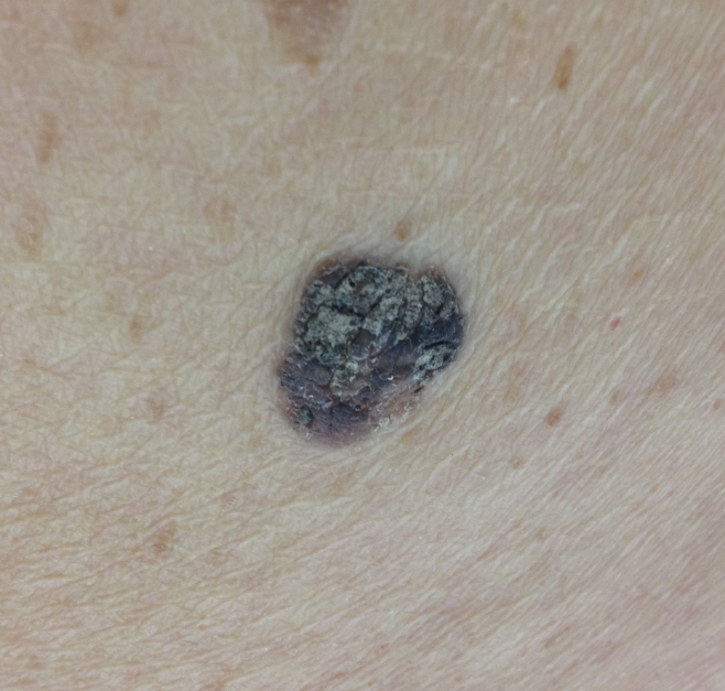 An 80-year-old woman comes to the office for evaluation of a skin lesion.  She has a black nodule on her back that has been present  for quite a while.   The nodule has occasional associated itching, but no pain, bleeding, or recent change in appearance.  Medical history is notable for hypertension, hypothyroidism, and mild dementia.  The patient lives in an assisted living facility and does not use tobacco or alcohol.  On examination, there is a raised nodule with a rubbery texture and oily surface, as shown in the image below.   What is the most likely diagnosis? A) Acrochordon B) Actinic keratosis C) Basal cell carcinoma D) Cutaneous wart E) Melanoma F) Seborrheic keratosis
