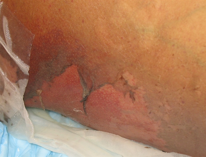 A 45-year-old man comes to the office after sudden onset of a skin rash and oral lesions with fever.  The patient is unable to eat or drink due to pain in his mouth and throat.  His wife says that he had a headache, malaise, and joint pain prior to developing the skin lesions.  The patient was in generally good health other than an episode of sinusitis for which he was prescribed trimethoprim-sulfamethoxazole 5 days ago.  His temperature is 38.3 C (101 F) , blood pressure is 110/80 mm Hg, pulse is 92/min, and respirations are 14/min.  On examination, conjunctivae in both eyes are inflamed.  The patient has extensive erosions involving the oral mucosa.  There is also an erythematous, desquamating rash with scattered involvement of the trunk and proximal thighs, as shown in the image below.   Which of the following is the most likely diagnosis? A) Erythema multiforme B) Impetigo C) Pemphigus vulgaris D) Staphylococcal scalded skin syndrome E) Stevens-Johnson syndrome F) Toxic shock syndrome