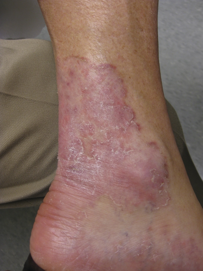 A 52-year-old man comes to the office due to an enlarging rash at the left ankle and upper back.  The rash began 6 weeks ago and is associated with significant itching.  The patient has tried topical antihistamines and calamine lotion without relief.  Medical history is otherwise unremarkable.  Temperature is 36.9 C (98.4 F) , blood pressure is 135/82 mm Hg, pulse is 76/min, and respirations are 12/min.  BMI is 25 kg/m<sup>2</sup>.  Examination shows a rash at the ankle, as seen in the image below, and a similar rash is noted at the upper back.   Which of the following is the most likely diagnosis in this patient? A) Erythema marginatum B) Erythema migrans C) Nummular eczema D) Pityriasis rosea E) Tinea corporis