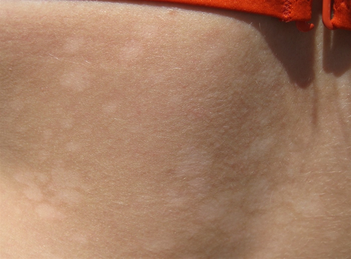 A 24-year-old woman comes to the office due to skin lesions on her trunk and proximal upper limbs.  The patient noticed the lesions after returning from a summer vacation at a Florida beach a week ago.  During the vacation, she had sun exposure on several occasions without prior application of sunscreen.  The lesions are mildly itchy but not painful.  Medical history is notable for hypothyroidism, for which she takes levothyroxine.  She drinks alcohol on social occasions but does not use tobacco or illicit drugs.  Examination shows hypopigmented lesions as shown in the image below.   Which of the following is the most likely cause of this patient's current condition? A) Autoimmune melanocyte injury B) Candida albicans infection C) Chemical irritant exposure D) Dermatophyte skin infection E) Epidermal hyperproliferation F) Malassezia globosa infection G) Ultraviolet skin damage
