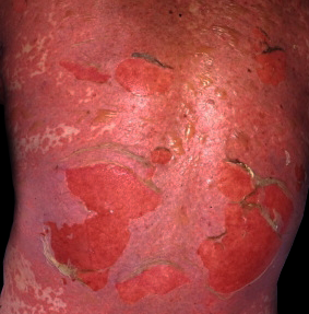 A 42-year-old woman comes to the emergency department with extensive, painful skin lesions.  She is unable to eat or drink due to painful blistering and ulceration in her mouth and throat.  The rash was preceded by fever, headache, sore throat, cough, nausea, and vomiting.  She was treated for acute cystitis with trimethoprim-sulfamethoxazole 5 days ago, but her history is otherwise unremarkable.  Temperature is 38.3 C (101 F) , blood pressure is 95/60 mm Hg, pulse is 110/min, and respirations are 14/min.  On examination, the skin is hot and tender with widespread confluent erythematous macules that cover most of the visible skin surface on her entire body.  The oral mucosa shows blistering and erosions.  A representative photograph from her back is shown below.   What is the most likely diagnosis? A) Erythema multiforme B) Exfoliative dermatitis C) Staphylococcal scalded skin syndrome D) Stevens-Johnson syndrome E) Toxic epidermal necrolysis