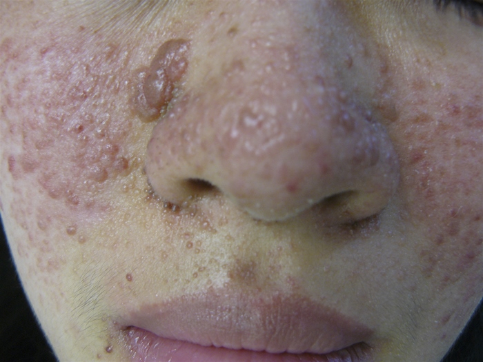 A 19-year-old woman comes to the office for evaluation of chronic acne.  Over the last 6 months, the patient has tried several over-the-counter acne treatments without improvement.  She has a history of attention-deficit hyperactivity disorder and mild intellectual disability.  Her mother has a seizure disorder, and her maternal grandmother died of kidney failure.  Vital signs are within normal limits.  Facial examination findings are shown below.   There are several elliptical, hypopigmented macules on the trunk.  Which of the following is the most likely underlying cause of this patient's condition? A) Congenital adrenal hyperplasia B) Fabry disease C) Neurofibromatosis type 1 D) Tuberous sclerosis E) Von Hippel-Lindau disease