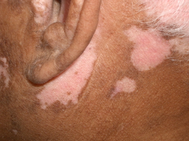 A 65-year-old man comes to the office due to a skin condition.  For the last 6 years, the patient has had slowly progressive, patchy depigmentation involving the face, posterior scalp, hands, genital area, and feet.  There is no associated itching, pain, or scaling.  Medical history is notable for hypertension, stable coronary artery disease, rheumatoid arthritis, and benign prostatic hyperplasia.  The patient quit smoking 20 years ago and does not use alcohol or illicit drugs.  Temperature is 36.9 C (98.4 F) , blood pressure is 136/88 mm Hg, and pulse is 76/min.  Skin examination shows widespread areas of depigmentation as shown below.  Physical examination is otherwise unremarkable.   Which of the following best explains the pathology of this patient's condition? A) Age-related depigmentation B) Destruction of melanocytes C) Inherited absence of melanocytes D) Mycobacterial infection E) Post-inflammatory change F) Superficial fungal infection
