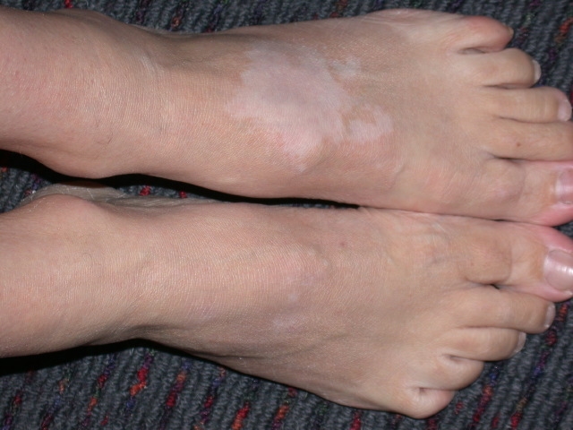 A 22-year-old woman comes to the office due to a skin disorder.  The patient has a 5-year history of patchy depigmentation primarily affecting the hands, feet, and face.  Some of her lesions have resolved, but overall she has experienced a slowly progressive course.  The patient has no associated pain, itching, or erythema.  Medical history is unremarkable, and her only regular medication is an oral contraceptive.  Vital signs are normal.  Physical examination findings are shown in the image below with similar lesions on the face and hands.  Examination is otherwise normal.   Which of the following diseases is most likely associated with this patient's skin condition? A) Hashimoto thyroiditis B) HIV infection C) Hyperparathyroidism D) Type 2 diabetes mellitus E) Zollinger-Ellison syndrome