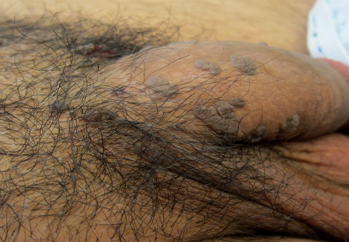 A 37-year-old man comes to his primary care physician for the evaluation of slightly pruritic skin lesions on his penis and around his anus.  He has no fever, malaise, or anorexia.  He is sexually active with multiple male partners and uses condoms occasionally.  The patient has never been tested for HIV or other sexually transmitted diseases.  He has no drug allergies.  Examination shows skin-colored, verrucous, papilliform lesions as shown in the image below.   Which of the following is the most likely cause of this patient's skin condition? A) Anatomical variation B) Herpes simplex virus C) Human papillomavirus D) Poxvirus E) Treponema pallidum