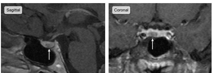 A 37-year-old woman comes to the office with a 7-month history of galactorrhea and amenorrhea.  She has also had worsening vaginal dryness, but no headaches or visual symptoms.  The patient's medical history is unremarkable, and she does not use tobacco, alcohol, or illicit drugs.  She is married, has 2 children, and remarks that her family is  complete.   The patient's husband has undergone vasectomy.  Her temperature is 36.7 C (98 F) , blood pressure is 120/80 mm Hg, pulse is 72/min, and respirations are 14/min.  Visual field testing is normal.  Pregnancy test is negative, serum prolactin level is 150 ng/mL (154 ng/mL on repeat measurement) , and thyrotropin (TSH)  and serum creatinine are normal.  MRI of the pituitary gland reveals a 6-mm hypointense lesion, as shown in the image below, which is consistent with a pituitary adenoma.   Which of the following is the most appropriate next step in management of this patient? A) Monitoring by periodic serum prolactin and MRI B) Radiotherapy C) Transsphenoidal surgery D) Treatment with cabergoline E) Treatment with estrogen