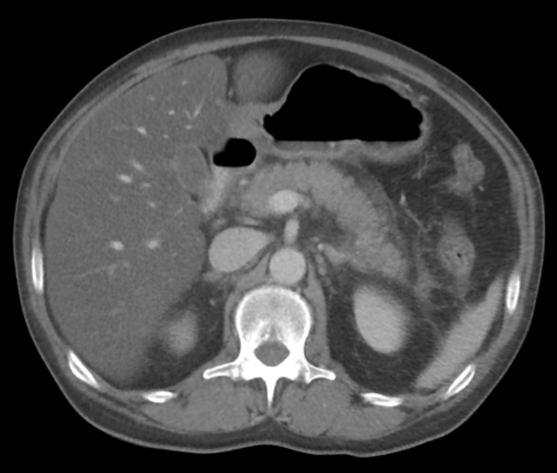 A 54-year-old man comes to the emergency department complaining of several days of persistent abdominal pain.  He also complains of nausea, vomiting, low-grade fever, and appetite loss.  He does not drink alcohol.  The patient is being treated for seizure disorder; his last seizure was 3 months ago.  Chest and abdominal x-rays reveal no abnormalities.  The patient's abdominal CT scan is shown below.   Which of the following is the most likely cause of this patient's current symptoms? A) Gallbladder disease B) Liver disease C) Mesenteric ischemia D) Pancreatic disease E) Peptic ulcer disease