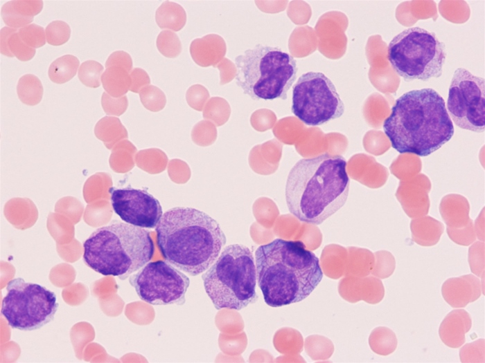 A 41-year-old man comes to the office due to worsening fatigue and dyspnea on exertion.  Over the past week, he has been feeling short of breath while riding his bike to work, which is unusual for him.  He has had no chest pain, palpitations, syncope, or pedal edema.  The patient has no prior medical conditions and takes no medications.  He occasionally drinks alcohol but does not use tobacco or illicit drugs.  Temperature is 37.2 C (99 F) , blood pressure is 130/80 mm Hg, pulse is 96/min, and respirations are 18/min.  Physical examination shows moist mucous membranes, normal thyroid, clear lungs, and normal heart sounds.  The abdomen is soft and nontender with normal bowel sounds.  Laboratory results are as follows.   Peripheral blood smear shows numerous atypical leukocytes, some of which contain cytoplasmic inclusions, as shown below.   This patient is at greatest risk of which of the following due to his current condition? A) Consumption coagulopathy B) Hyperviscosity syndrome C) Inflammatory myopathy D) Spontaneous spleen rupture E) Subacute spinal cord degeneration