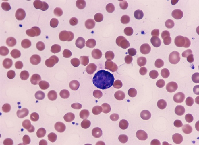 A 20-year-old man from northern Europe comes to the emergency department with a 2-month history of intermittent right upper quadrant pain.  The patient's medical history is unremarkable, and he considers himself healthy.  His mother had her gallbladder removed at a young age.  Abdominal ultrasound reveals cholelithiasis.  Laboratory results show a hemoglobin level of 10.2 g/dL.  Peripheral blood smear is shown in the image below.   This patient most likely has which of the following additional laboratory findings? A) Absence of CD55 in red blood cell membranes B) High hemoglobin A2 and hemoglobin F levels C) High mean corpuscular hemoglobin concentration D) High mean corpuscular volume E) Low serum iron and ferritin levels