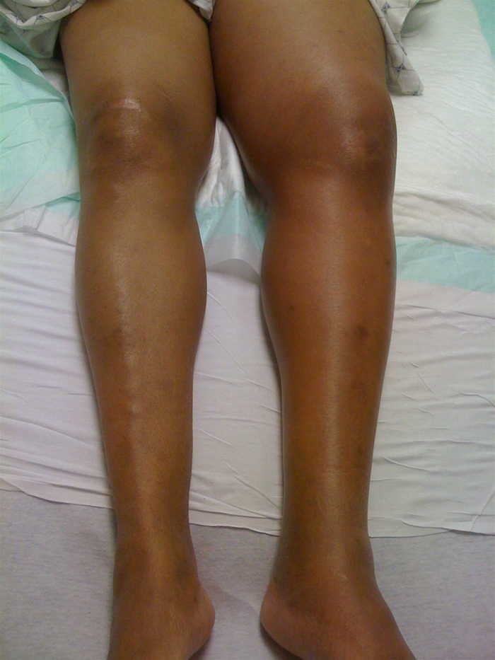 A 45-year-old woman comes to the emergency department with left leg pain and swelling that has worsened over the last 2 days.  The patient has no fevers, chills, dyspnea, or chest pain and has had no trauma to the left leg.  Her medical history includes rheumatoid arthritis and gastroesophageal reflux disease, for which she takes low-dose methotrexate, folic acid, and omeprazole.  The patient has smoked a pack of cigarettes daily for 10 years and does not consume alcohol.  Temperature is 37 C (98.6 F) , blood pressure is 140/80 mm Hg, pulse is 70/min, and respirations are 14/min.  BMI is 30 kg/m<sup>2</sup>.  The left leg is swollen (>4 cm)  compared to the right and is warm and tender on palpation.  Pitting edema is present.  Her legs are shown in the image below.   Which of the following is the most appropriate next step in management of this patient? A) Aspirin B) Blood cultures followed by antibiotics C) Chest CT angiogram D) Compression ultrasonography E) D-dimer test F) Empiric anticoagulation
