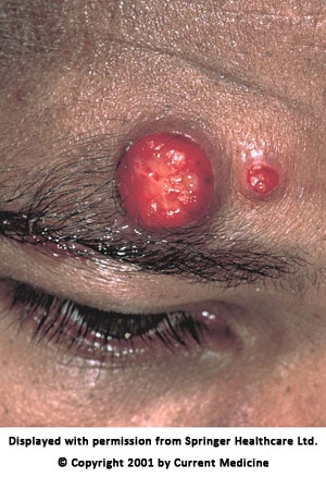 A 30-year-old man comes to the office due to skin lesions, fever, and malaise for the last week.  The patient was diagnosed with HIV 3 years ago.  His medication regimen includes antiretroviral therapy and trimethoprim-sulfamethoxazole.  Temperature is 39.3 C (102.7 F) , blood pressure is 115/75 mm Hg, pulse is 84/min, and respirations are 18/min.  Examination shows several 1-2 cm round, reddish, vascular, non-tender, and friable exophytic nodules, as shown below in the picture.   Which of the following is the most likely diagnosis in this patient? A) Kaposi sarcoma B) Extrapulmonary Pneumocystis infection C) Bacillary angiomatosis D) Molluscum contagiosum E) Herpes simplex