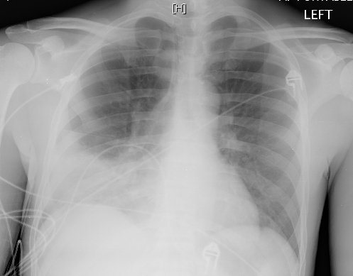 A 23-year-old woman comes to the emergency department due to 3 days of fever, chills, cough productive of clear sputum, and pain in her right lower chest with deep inspiration and cough.  She has had no sore throat, nasal discharge, or sick contacts.  The patient has a history of HIV and takes combination antiretroviral therapy as prescribed.  CD4 count was 300/mm<sup>3</sup> at routine office follow-up a month ago.  She does not use tobacco, alcohol, or illicit drugs.  Temperature is 39 C (102.2 F) , blood pressure is 115/76 mm Hg, pulse is 104/min, and respirations are 22/min.  Oropharyngeal mucosa is normal and there is no cervical lymphadenopathy.  Cardiopulmonary auscultation reveals a soft midsystolic murmur at the upper left sternal border and crackles in the right lower posterior chest.  Chest x-ray is shown below.   Which of the following is the most likely organism responsible for this patient's current symptoms? A) Aspergillus fumigatus B) Coccidioides immitis C) Klebsiella pneumoniae D) Mycobacterium tuberculosis E) Mycoplasma pneumoniae F) Pneumocystis jirovecii (formerly P carinii)  G) Pseudomonas aeruginosa H) Staphylococcus aureus I) Streptococcus pneumoniae