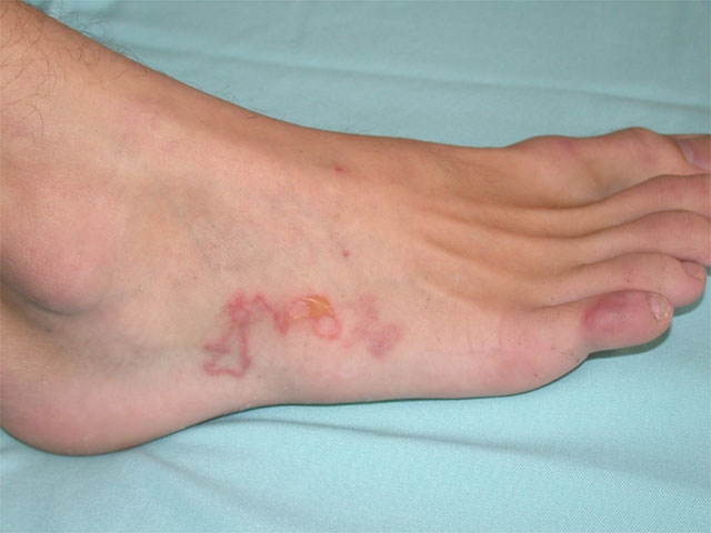 A 34-year-old man comes to the office during summer due to intensely pruritic lesions on his right foot.  The patient has no chronic medical conditions and has never had similar symptoms before.  He smokes a pack of cigarettes daily and drinks alcohol on social occasions.  The patient works as a landscaper and recently went to a company barbeque lunch.  His vital signs are normal.  Physical examination findings are shown below.   Which of the following most likely occurred before the patient developed these symptoms? A) Bite from a brown recluse spider B) Consumption of undercooked pork C) Contact with plant sap containing urushiol D) Trauma from decaying vegetation E) Walking barefoot on a sandy beach