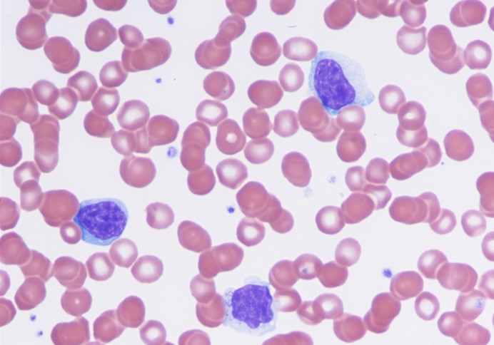 A 26-year-old man comes to the office due to a week of fever, malaise, fatigue, and sore throat.  The patient has no chronic medical conditions and takes no medications.  He drinks 1 or 2 beers on the weekends but does not use tobacco or illicit drugs.  The patient has had 3 male sexual partners over the past year and uses condoms inconsistently.  Temperature is 38.3 C (101 F) , blood pressure is 120/76 mm Hg, pulse is 75/min, and respirations are 14/min.  Physical examination shows pharyngeal erythema, mild splenomegaly, and a morbilliform rash.  No enlarged lymph nodes are present.  Laboratory results are as follows:   Peripheral blood smear is shown in the exhibit below.  Heterophile antibody testing is negative.  Which of the following is the most likely diagnosis?   A) Acute lymphoblastic leukemia B) Acute toxoplasmosis C) Cytomegalovirus infection D) Disseminated gonorrhea E) Herpangina F) Streptococcal pharyngitis