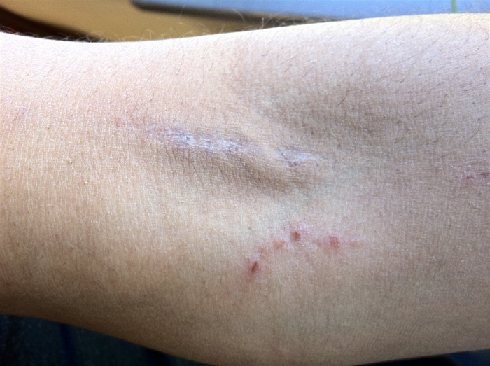 A 28-year-old woman comes to the emergency department with fever, chills, and generalized weakness for the past week.  Her only other medical problem was a hospital admission for right arm cellulitis 6 months ago.  Temperature is 40.0° C (104° F) , blood pressure is 110/65 mm Hg, pulse is 110/min, and respirations are 18/min.  Examination shows a normal oropharynx, and lungs are clear to auscultation.  A holosystolic murmur is heard at the lower sternum which increases in intensity with inspiration.  Examination of the right arm is shown in the image below.   Blood is drawn and sent for culture.  Which of the following is the most appropriate initial antibiotic therapy for this patient? A) Ampicillin-sulbactam B) Clindamycin C) Oxacillin D) Penicillin G and gentamicin E) Vancomycin