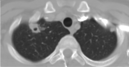 A 32-year-old woman comes to the hospital complaining of fever, chills, pleuritic chest pain, and shortness of breath for the last 3 days.  She was found to be HIV positive 1 year ago; her CD4 count was 378/µL about 1 month ago.  The patient does not regularly attend clinic appointments and takes no medications.  She uses intravenous heroin and cocaine.  Her only sexual partner is also HIV positive.  Her temperature is 39.3° C (102.7° F) , blood pressure is 120/68 mm Hg, pulse is 110/min, and respirations are 22/min.  Examination shows scattered crackles in both lung fields.  Her abdomen is soft and nontender without hepatosplenomegaly.  Her extremities exhibit several needle marks.  Laboratory results are as follows:   Imaging of the chest reveals multiple nodular lesions with small cavities, as shown below.       Which of the following organisms is most likely responsible for this patient's current condition? A) Haemophilus influenzae B) Legionella pneumophila C) Mycobacterium tuberculosis D) Pneumocystis jiroveci E) Staphylococcus aureus F) Staphylococcus epidermidis G) Streptococcus pneumoniae