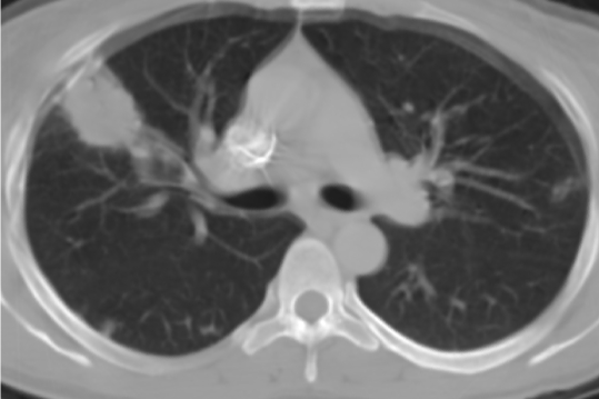 A 32-year-old woman comes to the hospital complaining of fever, chills, pleuritic chest pain, and shortness of breath for the last 3 days.  She was found to be HIV positive 1 year ago; her CD4 count was 378/µL about 1 month ago.  The patient does not regularly attend clinic appointments and takes no medications.  She uses intravenous heroin and cocaine.  Her only sexual partner is also HIV positive.  Her temperature is 39.3° C (102.7° F) , blood pressure is 120/68 mm Hg, pulse is 110/min, and respirations are 22/min.  Examination shows scattered crackles in both lung fields.  Her abdomen is soft and nontender without hepatosplenomegaly.  Her extremities exhibit several needle marks.  Laboratory results are as follows:   Imaging of the chest reveals multiple nodular lesions with small cavities, as shown below.       Which of the following organisms is most likely responsible for this patient's current condition? A) Haemophilus influenzae B) Legionella pneumophila C) Mycobacterium tuberculosis D) Pneumocystis jiroveci E) Staphylococcus aureus F) Staphylococcus epidermidis G) Streptococcus pneumoniae
