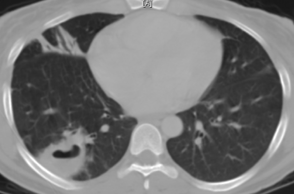 A 32-year-old woman comes to the hospital complaining of fever, chills, pleuritic chest pain, and shortness of breath for the last 3 days.  She was found to be HIV positive 1 year ago; her CD4 count was 378/µL about 1 month ago.  The patient does not regularly attend clinic appointments and takes no medications.  She uses intravenous heroin and cocaine.  Her only sexual partner is also HIV positive.  Her temperature is 39.3° C (102.7° F) , blood pressure is 120/68 mm Hg, pulse is 110/min, and respirations are 22/min.  Examination shows scattered crackles in both lung fields.  Her abdomen is soft and nontender without hepatosplenomegaly.  Her extremities exhibit several needle marks.  Laboratory results are as follows:   Imaging of the chest reveals multiple nodular lesions with small cavities, as shown below.       Which of the following organisms is most likely responsible for this patient's current condition? A) Haemophilus influenzae B) Legionella pneumophila C) Mycobacterium tuberculosis D) Pneumocystis jiroveci E) Staphylococcus aureus F) Staphylococcus epidermidis G) Streptococcus pneumoniae