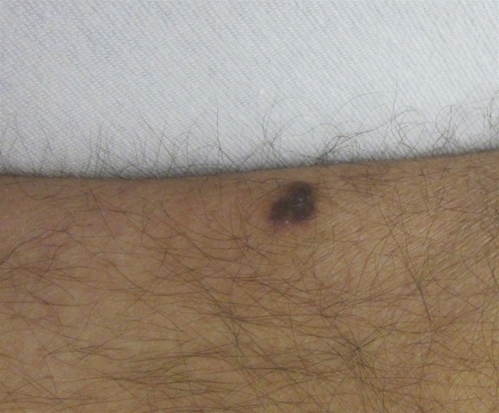 A 44-year-old man comes to the clinic for evaluation of a  mole.   He has a slowly enlarging macule that was first noticed by a sexual partner 6 weeks ago.  The lesion has no associated pain or itching, but it has changed in color from pink to violet.  On review of systems, he denies fever, night sweats, or urinary symptoms.  The patient reports an unintentional weight loss of approximately 8 kg (17.5 lb)  over the past year.  He was treated for syphilis 2 years ago with long-acting penicillin.  Otherwise, his medical history is insignificant.  He is not currently taking any medications.  The patient has had multiple male sexual partners in the last 20 years and works as a freelance website developer.  He does not use tobacco or illicit drugs but drinks alcohol heavily on weekends.  Temperature is 37.1 C (98.8 F) , blood pressure is 115/70 mm Hg, pulse is 80/min, and respirations are 14/min.  The skin lesion is shown in the image below.   Which of the following is the most likely cause of this patient's skin lesion? A) Bartonella henselae B) Cryptococcus neoformans C) Human herpesvirus 8 (HHV-8)  D) Human papillomavirus E) Pneumocystis jiroveci F) Poxvirus G) Treponema pallidum
