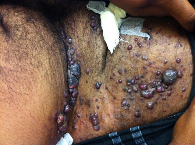 A 30-year-old man comes to the office for evaluation of 2 months of lower-extremity swelling and skin lesions.  He has no shortness of breath, fever, night sweats, or abdominal pain.  He has had some weight loss but is unable to quantify the exact amount.  The patient is an ex-intravenous drug user and was hospitalized 3 years ago for upper-extremity cellulitis.  Three months ago, he went to an urgent care clinic for white patches in his mouth.  His temperature is 37.2 C (99 F) , blood pressure is 132/78 mm Hg, and pulse is 92/min.  His BMI is 22 kg/m<sup>2</sup>.  Skin examination of the groin region is shown below.   Which of the following is the most likely diagnosis? A) Condylomata acuminata B) Kaposi sarcoma C) Leukocytoclastic vasculitis D) Malignant melanoma E) Neurofibromatosis