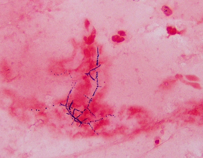 A 46-year-old man comes to the emergency department due to a week of fever, chills, productive cough with yellow-white sputum, and shortness of breath.  The patient received an allogenic renal transplantation 6 months ago and currently takes maintenance immunosuppressive therapy.  He is a former smoker and works in a post office.  Temperature is 39.4 C (102.9 F) , blood pressure is 110/65 mm Hg, pulse is 110/min, and respirations are 22/min.  Lung auscultation reveals left upper lung crackles and bronchial breath sounds.  Chest imaging reveals a left upper lobe nodular density with cavitation and nodular infiltrates in the right lung.  Sputum Gram stain and culture are negative.  Bronchoalveolar lavage cultures yield light growth of branching, filamentous rods that are partially acid-fast, as shown in the image below.  Which of the following is the most likely causative organism of this patient's condition?   A) Actinomyces species B) Aspergillus fumigatus C) Bacillus anthracis D) Klebsiella pneumoniae E) Mycobacterium tuberculosis F) Nocardia species G) Peptostreptococcus H) Streptococcus pyogenes