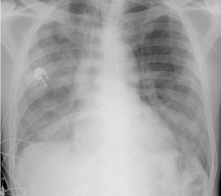 A 25-year-old man comes to the emergency department due to 3 weeks of progressive dyspnea on exertion, dry cough, fatigue, intermittent fever, and chills.  He was treated for genital herpes several years ago but otherwise has no significant medical history.  The patient does not use tobacco or illicit drugs but occasionally drinks alcohol.  He has been in a monogamous relationship for the past year and had multiple partners previously.  Temperature is 38.7 C (101.7 F) , blood pressure is 130/80 mm Hg, pulse is 90/min, and respirations are 28/min.  Pulse oximetry is 88% on room air.  Scattered white plaques are present on the oropharyngeal mucosa.  Lung auscultation reveals bilateral, diffuse crackles.  Chest x-ray is shown in the image below.   Arterial blood gas shows a PaO<sub>2</sub> of 60 mm Hg and a PaCO<sub>2</sub> of 33 mm Hg.  Induced sputum microscopy shows few leukocytes and no predominant organism.  Which of the following is most likely to be effective for this patient's pulmonary condition? A) Ceftriaxone and azithromycin B) Isoniazid, rifampin, pyrazinamide, and ethambutol C) Liposomal amphotericin B D) Trimethoprim-sulfamethoxazole and prednisone E) Vancomycin and piperacillin-tazobactam