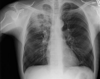 A 37-year-old man with HIV comes to the urgent care clinic due to 2 months of cough.  The cough is productive of sputum, particularly in the early morning, and is sometimes associated with streaks of blood.  He drinks alcohol and uses intravenous illicit drugs.  The patient was hospitalized 4 months ago due to alcohol-withdrawal seizures.  CD4 count at that time was 520/mm<sup>3</sup>.  Temperature is 37.7 C (99.9 F) , blood pressure is 130/80 mm Hg, pulse is 75/min, and respirations are 14/min.  Oxygen saturation is 98% on room air.  Lung examination reveals crackles and rhonchi over the right upper lung field.  No cardiac murmurs or rashes are present.  Chest x-ray findings are shown in the image below:   Which of the following is the most likely diagnosis for this patient? A) Aspiration pneumonia B) Cryptococcal pneumonia C) Mycobacterial infection D) Pneumocystis infection E) Septic pulmonary embolism