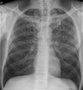 A 40-year-old man comes to the office due to progressively worsening shortness of breath and nonproductive cough over the last 3 weeks.  He also notes 2 months of fatigue, intermittent fever, and decreased appetite.  He has lost 6 kg (13.2 lb)  during this period.  He has no other medical problems.  He has a history of intravenous drug use and a 20-pack-year smoking history.  The patient was released from a 2 year incarceration 6 months ago.  Temperature is 38.3 C (100.9 F) , blood pressure is 110/70 mm Hg, pulse is 90/min, and respirations are 18/min.  The patient is in no distress but has mild temporal wasting.  Crackles are present throughout the lung fields.  Heart sounds are normal.  There is mild hepatomegaly.  Chest x-ray is shown below.   What is the most likely diagnosis? A) Hodgkin disease B) Lung metastasis C) Mycoplasma pneumonia D) Septic embolism E) Tuberculosis