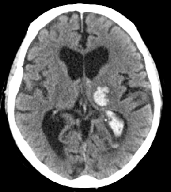 A 72-year-old woman is brought to the emergency department by her husband due to sudden-onset, right-sided weakness and numbness.  The patient's husband reports that her symptoms progressed over several minutes and were later accompanied by vomiting and headache.  He also notes that she is now excessively somnolent.  The patient has hypertension and persistent atrial fibrillation as well as myelodysplasia that has not required treatment.  She takes amlodipine, metoprolol, warfarin, and multivitamins.  In the past couple of days, she has also used over-the-counter medications for cold symptoms.  Temperature is 37 C (98.6 F) , blood pressure is 172/90 mm Hg, pulse is 68/min, and respirations are 16/min.  Her laboratory results and CT scan of the head without contrast are as follows:     Which of the following is the best immediate step in management of this patient? A) Aspirin and labetalol B) Lumbar puncture C) Platelet transfusion D) Protamine sulfate E) Prothrombin complex concentrate F) Tissue plasminogen activator G) Tranexamic acid