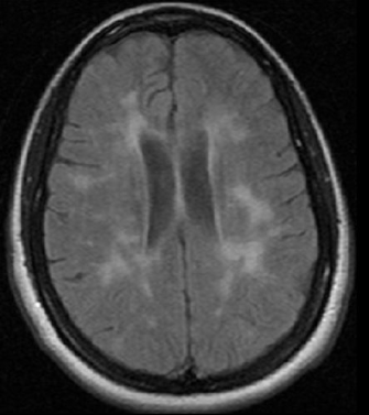 A 38-year-old woman comes to the emergency department due to a week of clumsiness and shaking in her right arm.  The patient also feels unsteady and has fallen twice in the past 2 days.  One year ago, she had diplopia and vertigo for 2 weeks that resolved without treatment.  The patient has no other medical problems.  She takes oral contraceptives and occasionally acetaminophen.  She does not use tobacco, alcohol, or illicit drugs.  She recently started a vegan diet.  Her father died of a large stroke, and her mother has diabetes mellitus.  Temperature is 37 C (98.6 F) , blood pressure is 140/85 mm Hg, and pulse is 84/min and regular.  BMI is 34 kg/m<sup>2</sup>.  On physical examination, there is mild right pronator drift but no muscle weakness.  The patient is unable to walk a tandem gait.  MRI of the brain without contrast is shown in the image below.   Which of the following is the most appropriate next step in management of this patient? A) Initiate acetazolamide B) Initiate aspirin and atorvastatin C) Initiate intravenous heparin D) Initiate methylprednisolone E) Initiate vitamin B F) Perform echocardiogram G) Perform lumbar puncture