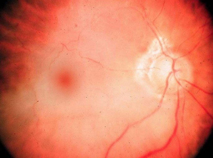 A 65-year-old man comes to the emergency department due to sudden-onset painless vision loss in the right eye that began several hours ago.  The patient says,  It was like a shade dropping over my eye.   He had a similar episode 3 months ago that resolved spontaneously after several minutes.  He has never seen flashing lights or floaters in his eyes.  The patient's medical history includes hypertension and hyperlipidemia.  Temperature is 37.1 C (98.8 F) , blood pressure is 150/90 mm Hg, pulse is 72/min and regular, and respirations are 14/min.  Visual acuity is 20/20 on the left and 20/200 on the right.  Funduscopy findings of the right eye are shown below.   Which of the following is the most likely cause of this patient's symptoms? A) Arterial embolic occlusion B) Malignant hypertension C) Retinal detachment D) Venous thrombotic occlusion E) Vitreous hemorrhage