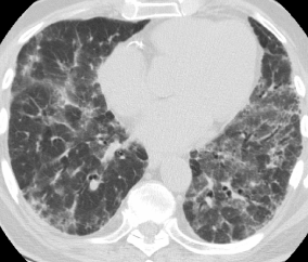 A 65-year-old woman is brought to the physician due to 6 months of dry cough and worsening dyspnea.  Her dyspnea has progressed so that she is now able to walk only a few steps.  She has no fever, chest pain, or hemoptysis.  Her only medication is hydrochlorothiazide for hypertension.  The patient is a retired schoolteacher and does not use tobacco or alcohol.  She has no pets and has never traveled abroad.  Temperature is 37.2 C (99 F) , blood pressure is 140/86 mm Hg, pulse is 84/min, and respirations are 18/min.  Chest examination shows dry, late inspiratory crackles and digital clubbing.  There is no peripheral edema.  Serology is negative for antinuclear antibodies and antineutrophil cytoplasmic antibodies.  Chest x-ray shows diffuse reticular opacities.  A high-resolution computed tomography scan is shown below.   Which of the following abnormalities is most likely to be present in this patient? A) Decreased FEV1/FVC ratio B) Increased alveolar-arterial gradient C) Increased diffusion capacity of carbon monoxide D) Increased PaCO<sub>2</sub> E) Increased residual volume