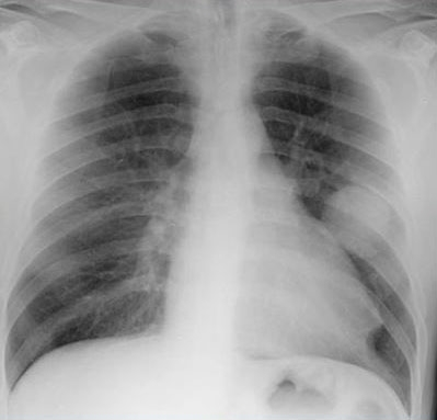 A 43-year-old man comes to the office due to several weeks of nagging, left-sided chest pain that worsens with deep inspiration.  He has also had a progressive, nonproductive cough and mild dyspnea.  The patient denies fever or chills.  He was diagnosed with Hodgkin lymphoma in his early 20s and was treated with chemotherapy and radiation.  Blood pressure is 144/90 mm Hg and pulse is 92/min.  The patient appears thin.  Examination is otherwise normal.  Chest x-ray is shown in the image below:   Which of the following is the most likely cause of this patient's current manifestations? A) Aspergillus infection B) Lung cancer C) Pulmonary tuberculosis D) Radiation-induced fibrosis E) Recurrence of Hodgkin lymphoma