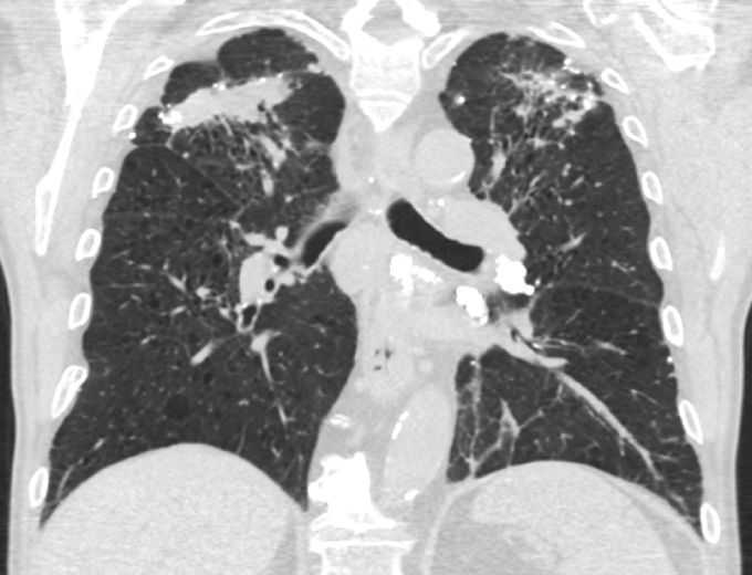 A 60-year-old man comes to the office for a work disability evaluation.  Since high school, the patient has worked in a factory manufacturing granite and quartz countertops.  His main concern is dyspnea that has slowly worsened over the last 2 years.  The patient has rheumatoid arthritis, for which he was prescribed methotrexate 5 years ago; he stopped taking it  some time ago  because his symptoms did not improve.  He owns an African Grey parrot and smoked heavily in his 30s and 40s.  Physical examination is notable for coarse inspiratory crackles and squawks that are loudest in the upper lung fields.  Bilateral digital clubbing and moderate metacarpophalangeal subluxation are present.  Pulmonary function tests demonstrate moderately reduced total lung capacity.  CT scan of the chest is shown in the image below:   Which of the following factors best explains this patient's respiratory disease? A) Adverse drug reaction B) Cigarette smoke C) Occupational dust exposure D) Parrot ownership E) Uncontrolled rheumatoid arthritis