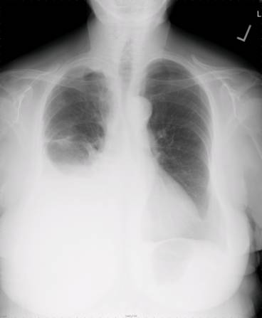A 60-year-old Caucasian female comes to the physician because of progressive shortness of breath for the past month. She has had a 13.6 kg (30 lb)  weight loss during this period. She has a history of hypertension and hypothyroidism and takes metoprolol and levothyroxine. She has smoked two packs of cigarettes daily for 35 years. Her temperature is 36.7° C (98° F) , blood pressure is 130/70 mmHg, pulse is 80/min, and respirations are 20/min. On examination, decreased breath sounds and dullness to percussion are noted on the right, middle and lower lobes of the lung. Her chest x-ray is shown below.   Which of the following is the most appropriate next step in the management? A) Bronchoscopy B) Mediastinoscopy C) Thoracentesis D) Video-assisted thoracoscopy E) Open pleural biopsy F) Echocardiography G) Diuretics