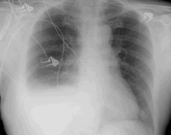 A 52-year-old woman comes to the office with worsening shortness of breath over the last 2 weeks.  Her symptoms are particularly worse at night.  The patient has no fever or cough.  She was diagnosed with breast cancer 2 years ago and had a left complete mastectomy.  Chest x-ray is shown in the image below.   Examination of this patient's right lower lung field would most likely show which of the following?   A) A B) B C) C D) D E) E