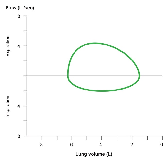 A 56-year-old woman is brought to the hospital from a local restaurant after suddenly becoming short of breath.  Her pulmonary flow-volume loop is shown below.   Which of the following is the most likely cause of her symptoms? A) Asthma attack B) Laryngeal edema C) Panic attack D) Pneumothorax E) Pulmonary edema